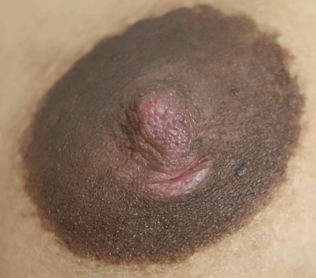 areola wound